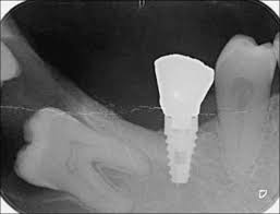 2. Distoangulada