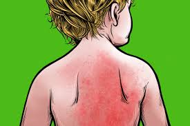 However, avoid using ice, cold water, fans or cold baths. How To Identify Common Childhood Rashes The New York Times