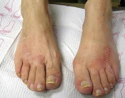 Here, we will look at the common causes, symptoms and treatment options for this common foot problem. Top Of The Foot Pain And Swelling Treatment