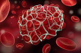 Symptoms Of A Blood Clot Prevention And Treatment Of Blood Clots