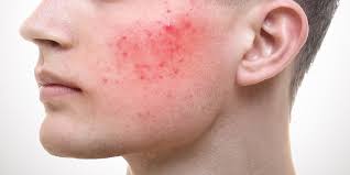 We did not find results for: Black Spots On Back Neck Shoulders Causes And Treatment