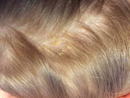 Get rid of dry itchy dandruff filled scalp: Wonder Review Uriage Cradle Cap Cream And Shampoo Wonderbaba