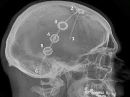 Saarland University Medical Center Shunt Implantation