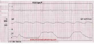 Image result for Synchronized Cardioversion