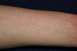 Image result for scabies effects on the human body