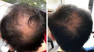 Laser cap reviews researches, tests, and provides unbiased feedback on laser caps, helmets, and other lllt devices. Irestore Laser Hair Growth System Full Review 2021 Hair Loss Geeks