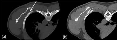 Image result for Scapulothoracic Injection