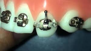 The best orthodontics tutorials available online What Makes Us Different Kirsch And Servello Orthodontics Ebensburg Pa