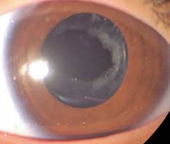 Bilateral Clear Lens Extraction And Intraocular Lens Implantation In A Child With Microspherophakia And Marfan Syndrome