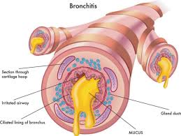 Image result for Acute Bronchitis