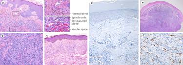 Contamos con el mejor ambiente para ti y tu familia. Kaposi Sarcoma Nature Reviews Disease Primers