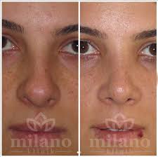 Burun Estetigi Ameliyati Ve Burun Estetigi Fiyatlari Milano Klinik Rinoplasti Bursa Estetik