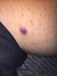 They look like small red dots on your skin, roughly the size of a pimple, and can become infected. Oh No Bad Ingrown Hairs After Brazilian Wax What To Do