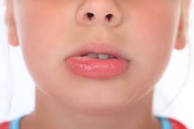 How To Get Rid Of A Mucous Cyst Or Mococele Mucous Cyst Lip Home Remedy Blister On Lip Blister In Mouth Swollen Lips