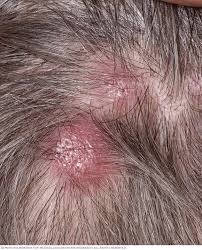 Image result for Lymphoma