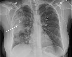 A new challenge for prevention and therapy. Cureus Community Acquired Pneumonia With Methicillin Resistant Staphylococcus Aureus In A Patient Admitted To The Intensive Care Unit A Therapeutic Challenge