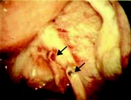 A pilot systematic review of the effects of aromatase inhibitors on pain associated with endometriosis. Endometriosis The Bmj