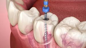 Ppo dental insurance does not cover all the costs of a root canal. How Much Is A Root Canal Without Insurance Insurance Noon