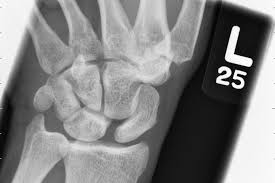 Image result for Scapholunate Dislocation