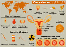 This is because cervical cancer can be prevented by regular cervical screening tests. What Causes Cervical Cancer