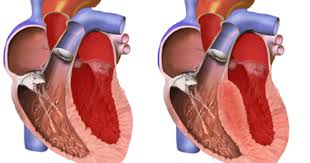 We did not find results for: Kardiomiopati Hipertrofik Informasi Kedokteran Dan Kesehatan