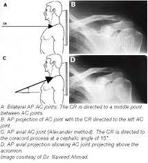 Additional imaging of the lung apices • properly positioned (not rotated or angulated): Boning Up On Humerus Clavicle And Ac Joint Positioning Diagnostic Imaging Radiology Student Radiology