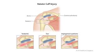 Image result for Rotator Cuff Injury