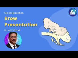 Image result for Brow Presentation