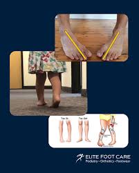 Image result for In-Toeing