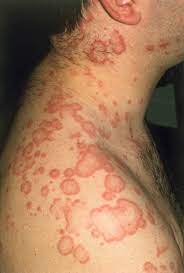 What To Look For With Drug Induced Urticaria Clinical Advisor