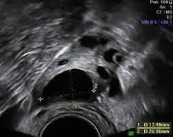 Pcos And Clomid Fertility Treatment And Pregnancy - Advanced Fertility  Center Of Chicago