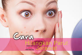 Cara Hilangkan Parut Jerawat Women Online Magazine