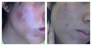 Vitamin e supplement for acne. Amazing Nutritional Supplements That Helped My Skin Photos Diet Holistic Health Acne Org