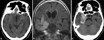 11 public playlist includes this case Herpes Simplex Virus Encephalitis Complicated By Intracerebral Hematoma