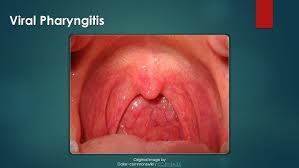 Image result for Pharyngitis