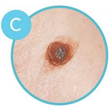 Detecting lip cancer early have good prognosis. Top 5 Skin Cancer Symptoms U S Dermatology Partners Blog