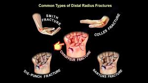 Image result for Fracture Type