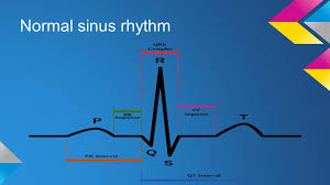 Normal cardiac impulses start there and are transmitted to the atria and down to the ventricles. Ecg Rhythm Recognition Ppt Video Online Download