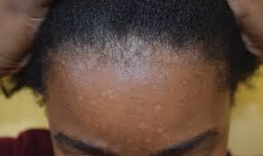The dermis is the second layer, thicker, while the l. Seborrheic Dermatitis Of The Face And Scalp In Skin Of Color Clinical Considerations Jddonline Journal Of Drugs In Dermatology