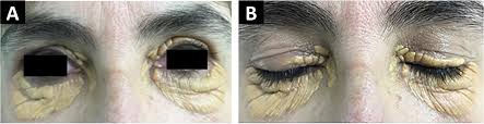 Image result for xantelasma