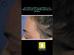 تساقط الشعر بعد عمليات التكميم Youtube