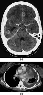 Term pregnancy (lasting the full nine months) significantly reduces the risk of ovarian cancer. Cancer Presenting During Pregnancy Radiological Perspectives Clinical Radiology