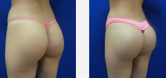 Augmentation des fesses & lifting. Augmentation Fesses Tunisie Prix Pose Implants Fessiers Pas Cher