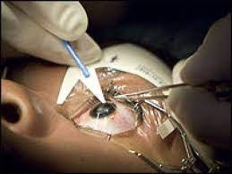 Low Cost Laser Eye Surgery In India Laser Eye Treatment In India Searching for the cost of eye surgery in india? low cost laser eye surgery in india