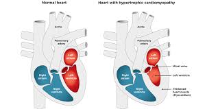 Image result for Cardiomyopathy