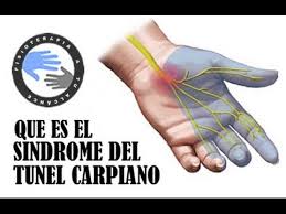 Sindrome Del Tunel Carpiano Que Es Y Porque Se Produce Youtube