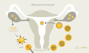 Tag nach der befruchtung übertragen werden, sich innerhalb der gebärmutter weiter zur blastozyste entwickeln und sich dann einnisten. Blastozystentransfer Bei Der Ivf Oder Icsi Vivaneo