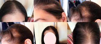 Forum Haarausfall Frauen Forum Frauen Dringend Guter Endokrinologe In Berlin