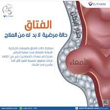 ريشة بلاط بعض الأحيان الفتق عند الرجال بالصور dsvdedommel com