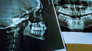 Image result for Skull XRay